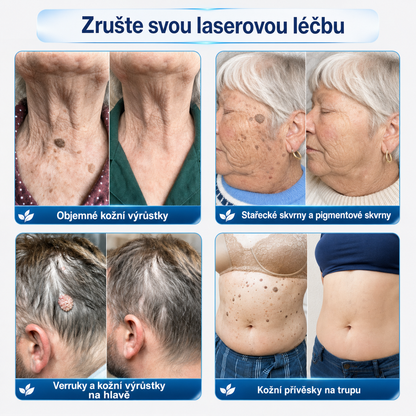 Oficiální obchod značky👨‍🔬Trilumia® 7denní odstraňovač kožních výrůstků a pigmentových skvrn🍔 (Bez bolesti, bez jizev – Roll-on)-7232