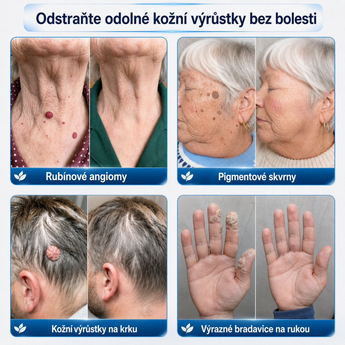 Oficiální obchod značky👨‍🔬Trilumia® 7denní odstraňovač kožních výrůstků a pigmentových skvrn🍔 (Bez bolesti, bez jizev – Roll-on)-7232