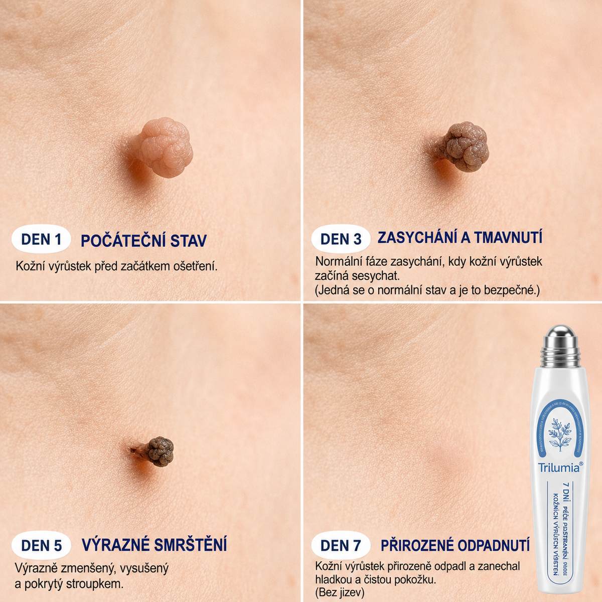 Oficiální obchod značky👨‍🔬Trilumia® 7denní odstraňovač kožních výrůstků a pigmentových skvrn🍔 (Bez bolesti, bez jizev – Roll-on)-7232